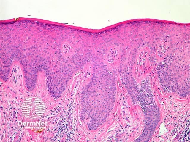 Chronic lichenified eczema