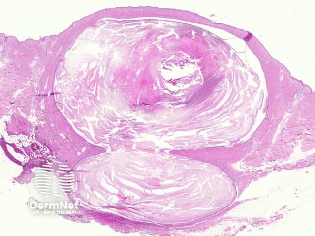 Epidermoid cyst