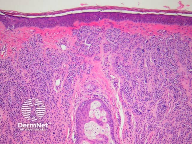 Intradermal naevus