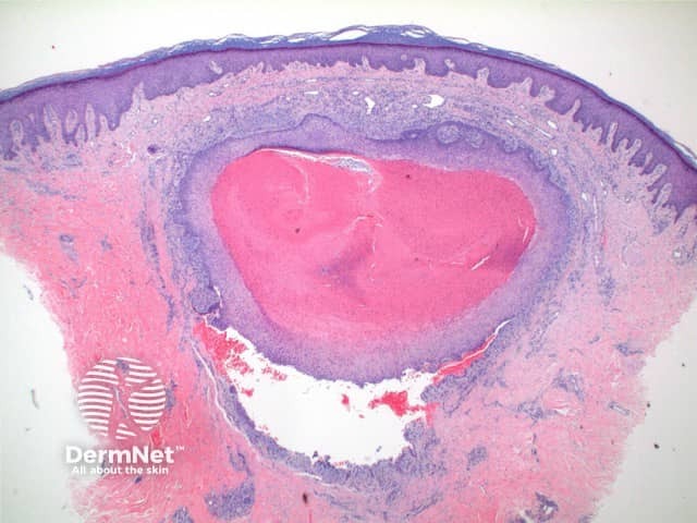 Trichilemmal cyst