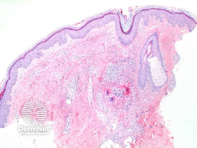 Pathology of leucocytoclastic vasculitis