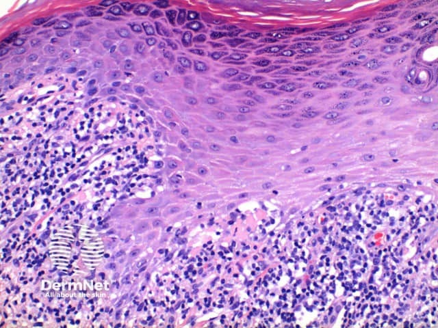 Pathology of lichen planus