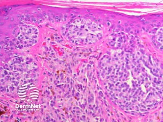 Pathology of melanoma