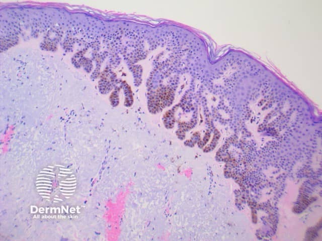 Pigmented seborrhoeic keratosis