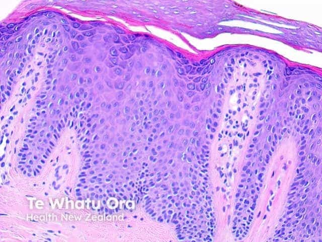 Pathology of psoriasis x200