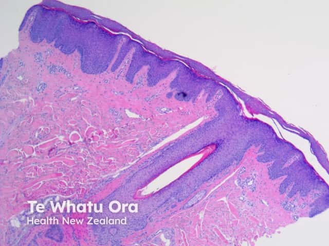 Pathology of psoriasis x40