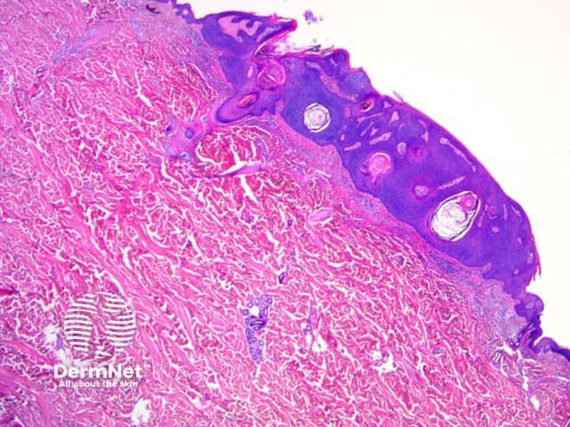 Seborrhoeic keratosis