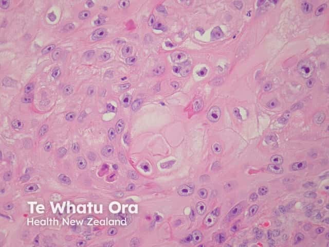 Pathology of squamous cell carcinoma keratinisation