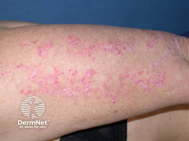 Psoriasis in Blaschko distribution