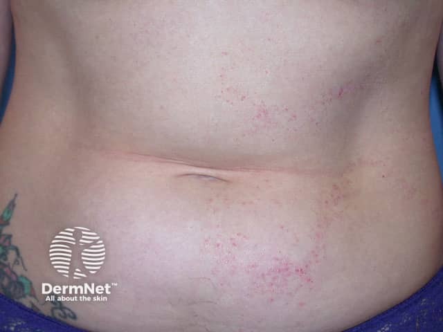 Psoriasis in Blaschko distribution