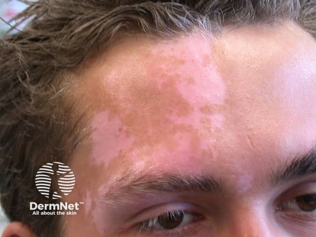 Segmental vitiligo