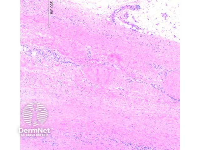 Thickened fascia with inflammatory infiltrate