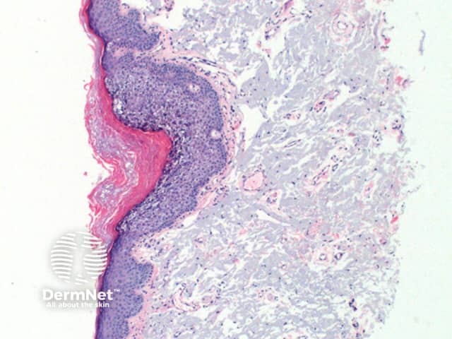 Epidermolytic hyperkeratosis pathology