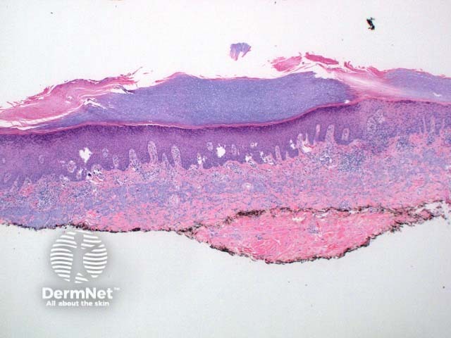 Porokeratosis pathology