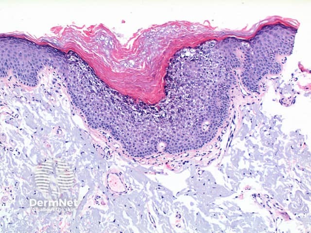 Epidermolytic hyperkeratosis pathology