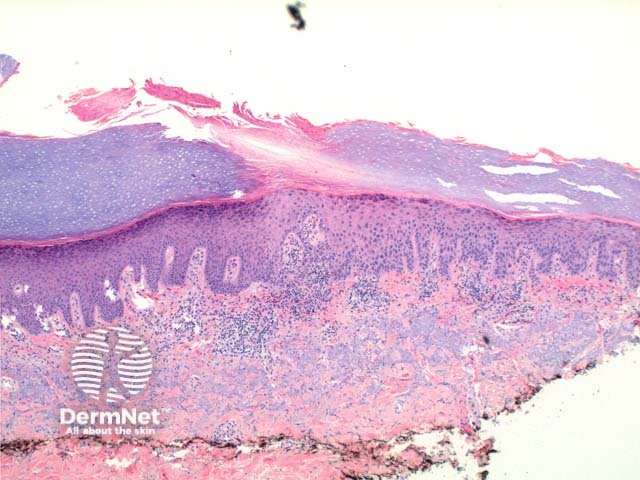 Porokeratosis pathology