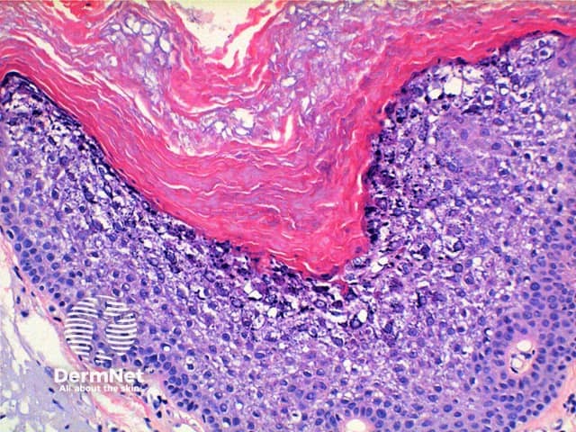 Epidermolytic hyperkeratosis pathology