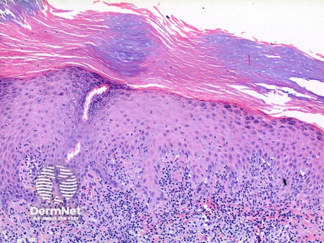 Porokeratosis pathology