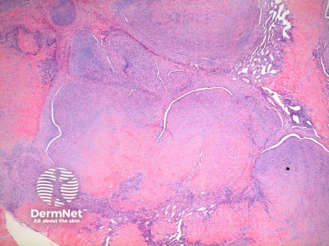 Myofibroma pathology