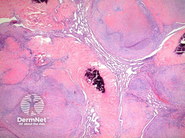 Myofibroma pathology