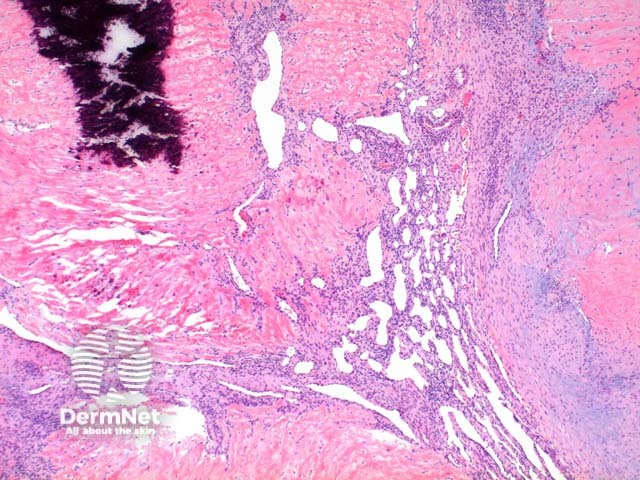 Myofibroma pathology