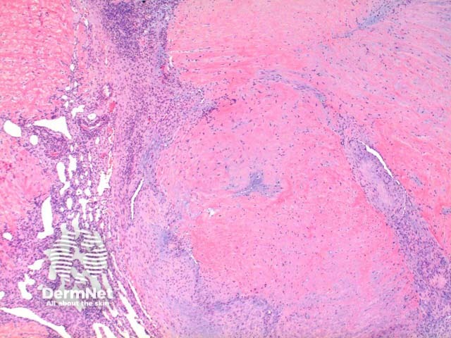 Myofibroma pathology