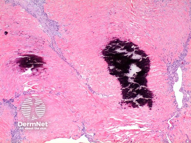 Myofibroma pathology