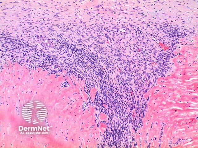 Myofibroma pathology