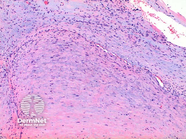 Myofibroma pathology