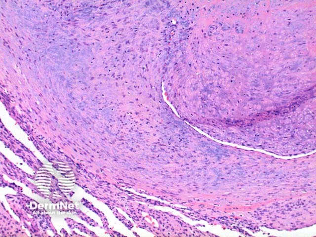 Myofibroma pathology