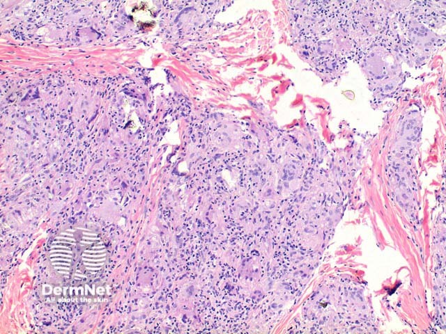 Sarcoidosis pathology