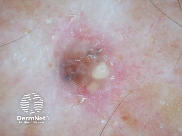 Pigmented basal cell carcinoma dermoscopy