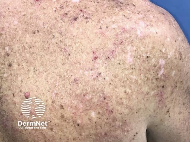 Eczema induced by pembrolizumab