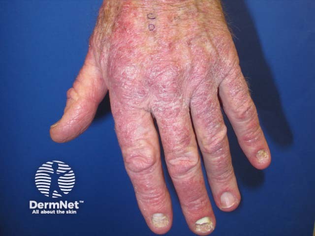 Pembrolizumab-induced psoriasis