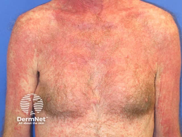 Pembrolizumab-induced psoriasis