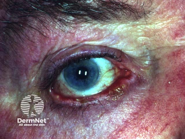 Blepharoconjunctivitis due to pemphigus vulgaris