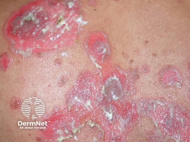 Pemphigus vulgaris