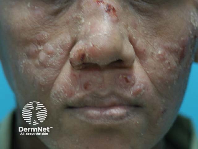 Facial nodules with talaromycosis