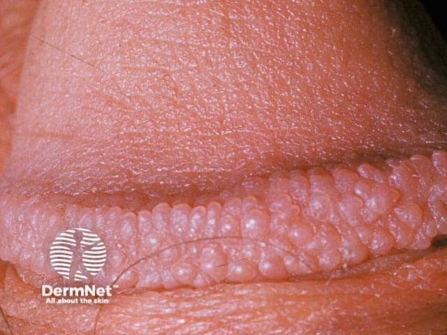 Pearly penile papules