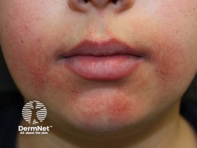 Periorificial dermatitis