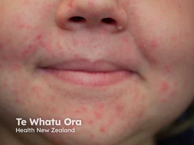 Periorificial dermatitis in a child