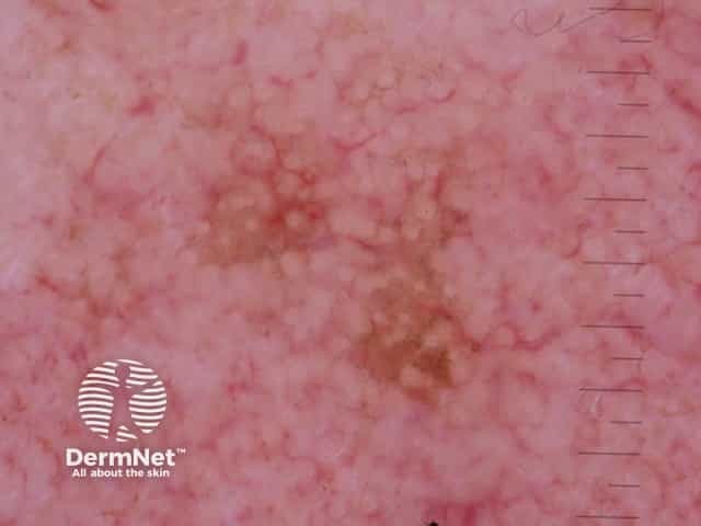 Pigmented actinic keratosis