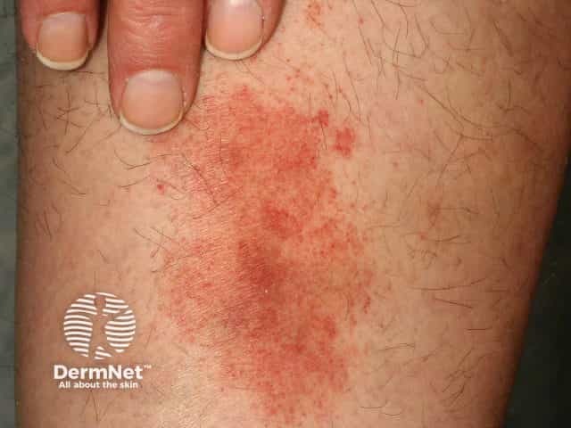 Pigmented purpuric dermatitis