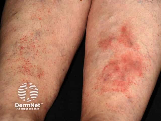 Pigmented purpuric dermatitis