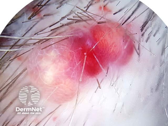 Dermoscopy of pilomatricoma