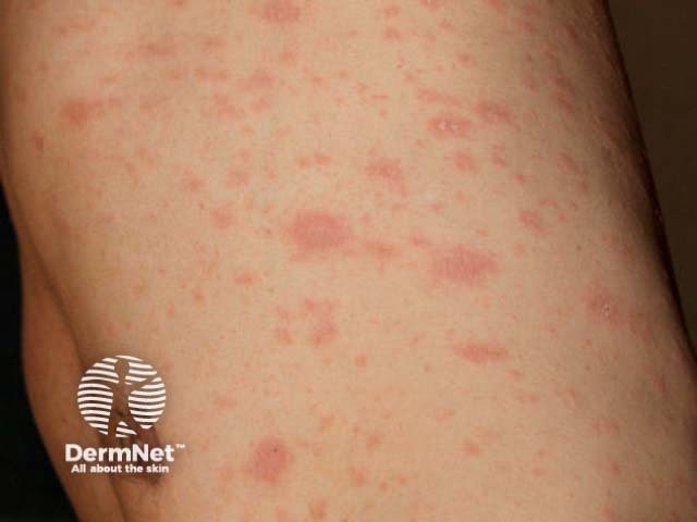 Pityriasis rosea