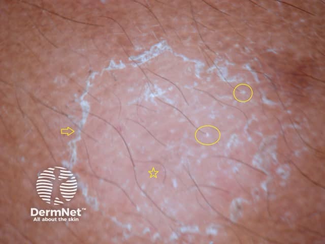 Pigment network (star), perifollicular scale (circles), peripheral scale (arrow)