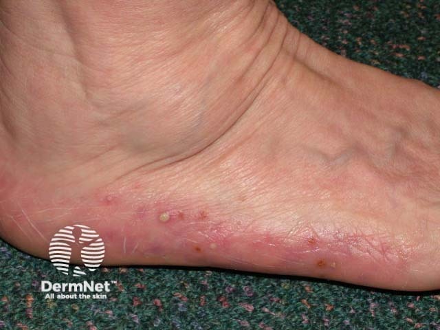 Plantar pustulosis