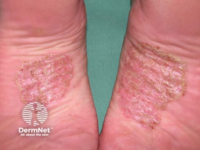 Plantar pustulosis