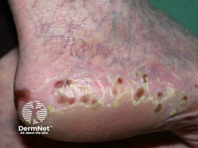 Plantar pustulosis